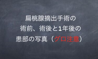 扁桃腺摘出手術の術前、術後と1年後の患部の写真（グロ注意）